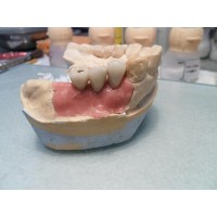 Prtesis sobre implantes